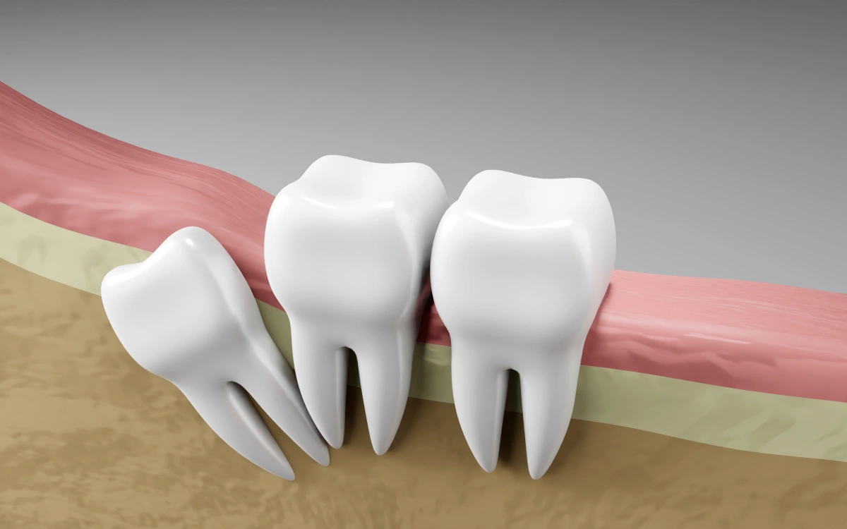 Dientes incluidos