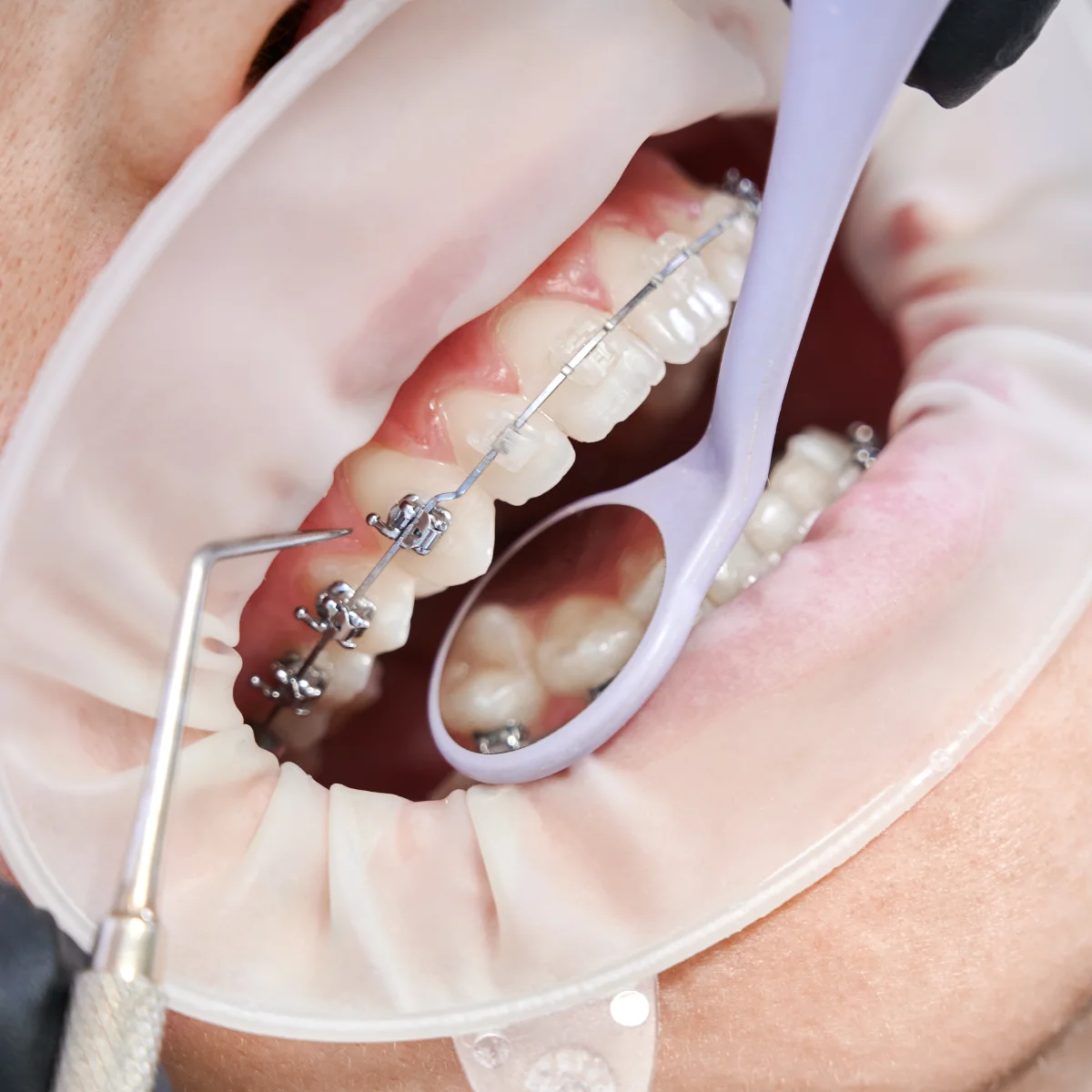 Ortodoncia con brackets